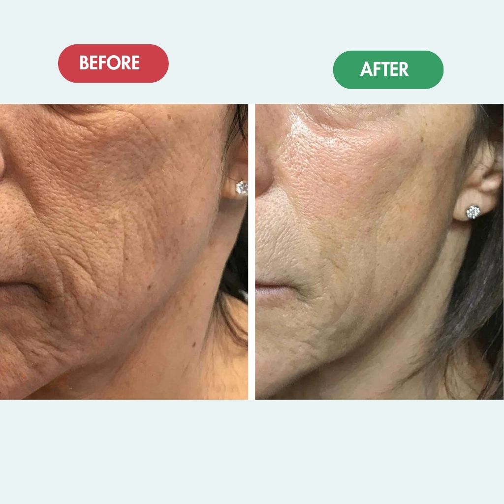 LUMIDERMIS™  - Regenmask